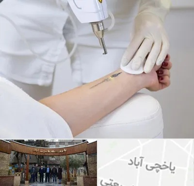 پاک کردن تتو با لیزر در یاخچی آباد