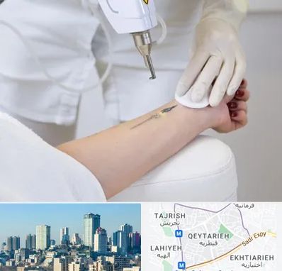 پاک کردن تتو با لیزر در قیطریه