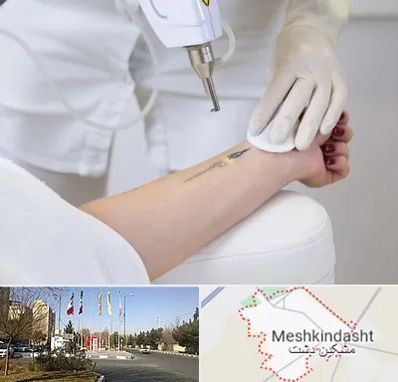 پاک کردن تتو با لیزر در مشکین دشت