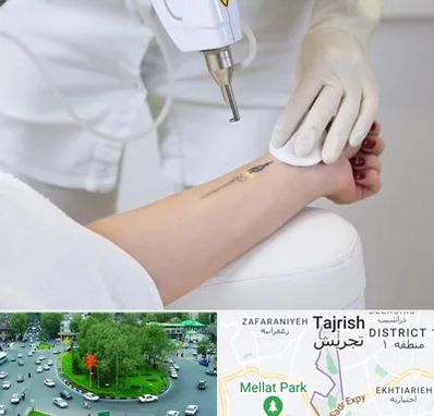 پاک کردن تتو با لیزر در تجریش