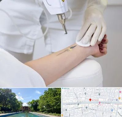 پاک کردن تتو با لیزر در هشت بهشت اصفهان