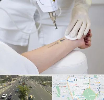 پاک کردن تتو با لیزر در منطقه 17 تهران