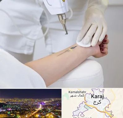 پاک کردن تتو با لیزر در کرج