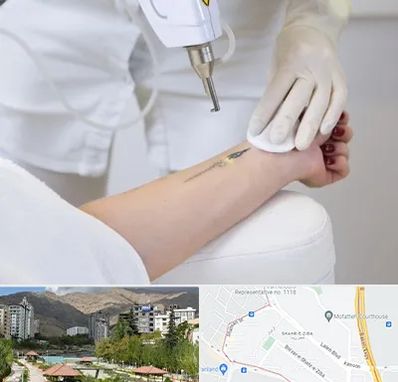 پاک کردن تتو با لیزر در شهر زیبا