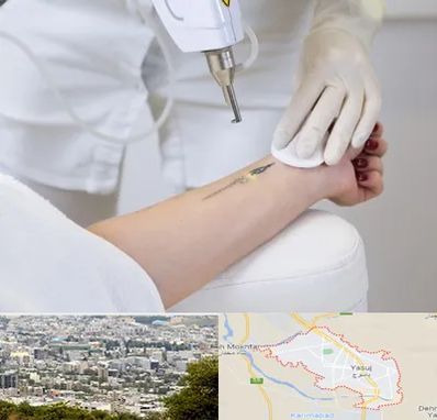 پاک کردن تتو با لیزر در یاسوج