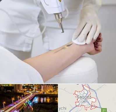 پاک کردن تتو با لیزر در سقز