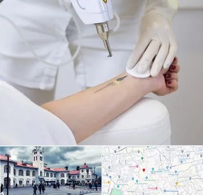 پاک کردن تتو با لیزر در میدان شهرداری رشت