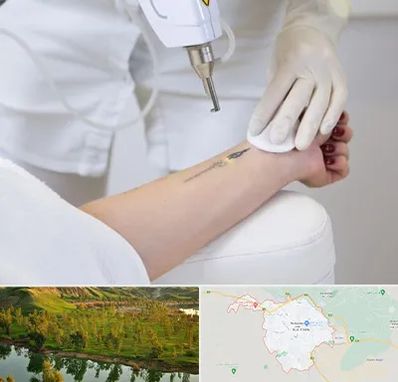 پاک کردن تتو با لیزر در بهبهان