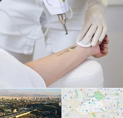 پاک کردن تتو با لیزر در منطقه 19 تهران