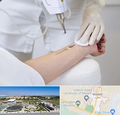 پاک کردن تتو با لیزر در ملارد