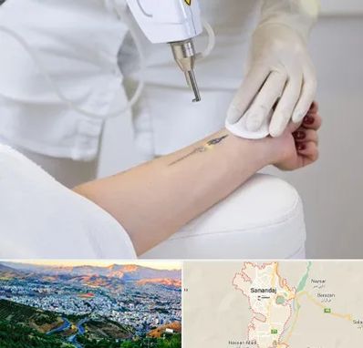 پاک کردن تتو با لیزر در سنندج