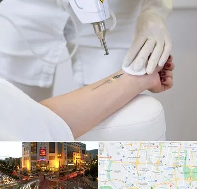 پاک کردن تتو با لیزر در جنت آباد تهران