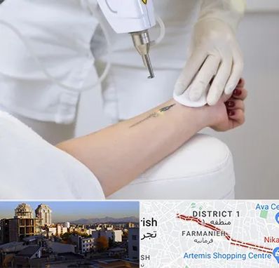 پاک کردن تتو با لیزر در فرمانیه