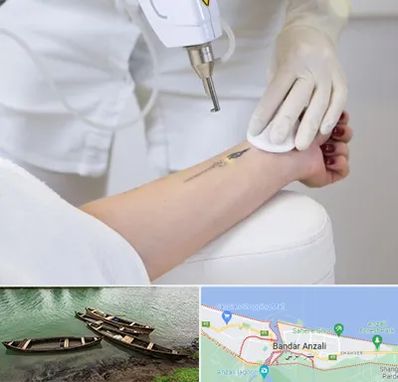 پاک کردن تتو با لیزر در بندر انزلی