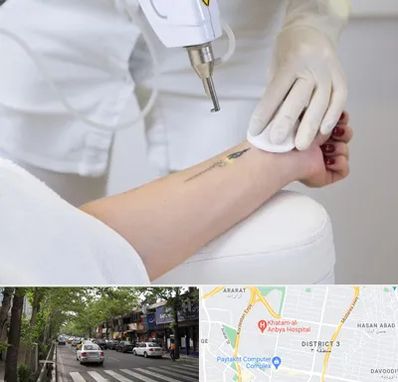 پاک کردن تتو با لیزر در ظفر