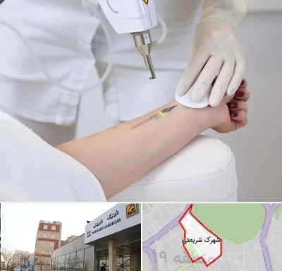 پاک کردن تتو با لیزر در شهرک شریعتی