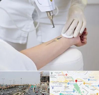 پاک کردن تتو با لیزر در بلوار توس مشهد