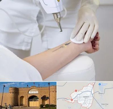 پاک کردن تتو با لیزر در ایرانشهر