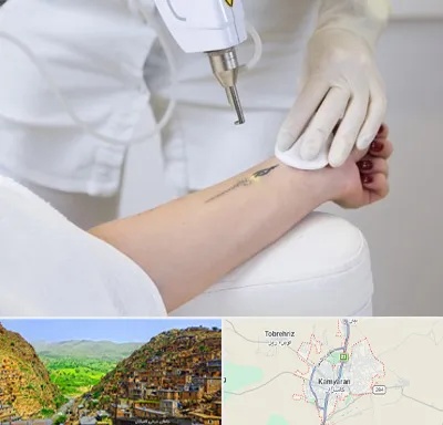 پاک کردن تتو با لیزر در کامیاران