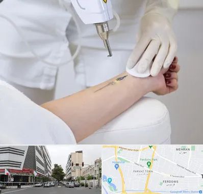 پاک کردن تتو با لیزر در بلوار فردوس