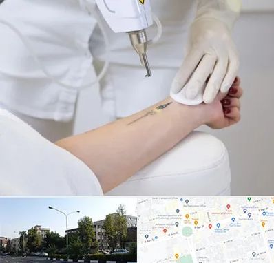 پاک کردن تتو با لیزر در میدان کاج