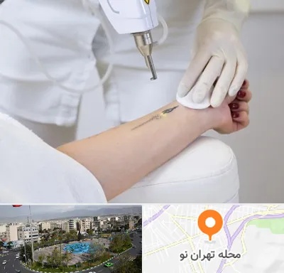 پاک کردن تتو با لیزر در تهران نو