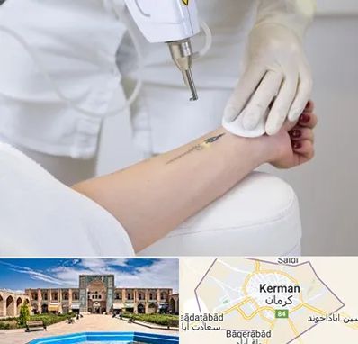 پاک کردن تتو با لیزر در کرمان
