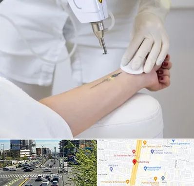 پاک کردن تتو با لیزر در ستاری