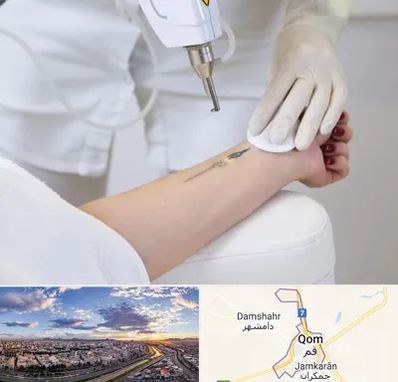 پاک کردن تتو با لیزر در قم