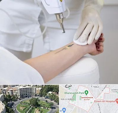 پاک کردن تتو با لیزر در جهانشهر کرج