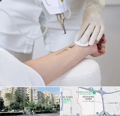 پاک کردن تتو با لیزر در آپادانا