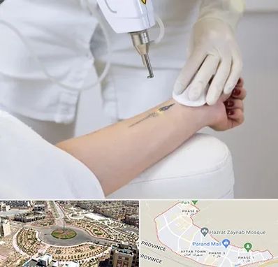 پاک کردن تتو با لیزر در پرند