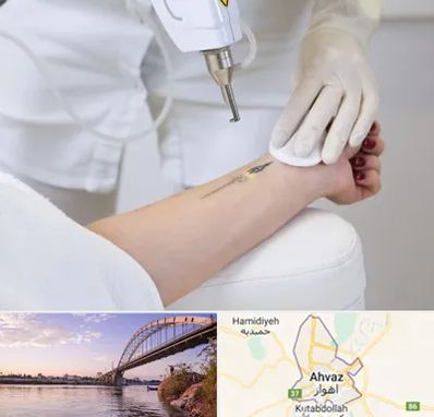 پاک کردن تتو با لیزر در اهواز