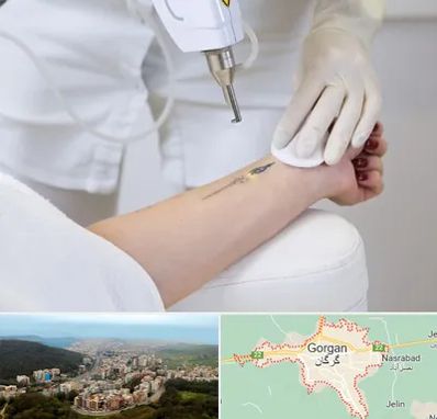 پاک کردن تتو با لیزر در گرگان