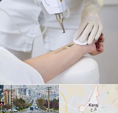 پاک کردن تتو با لیزر در گوهردشت