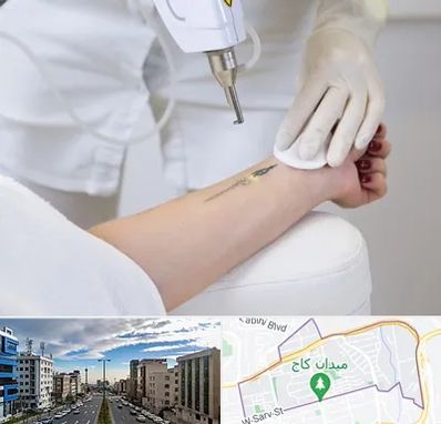 پاک کردن تتو با لیزر در سعادت آباد تهران