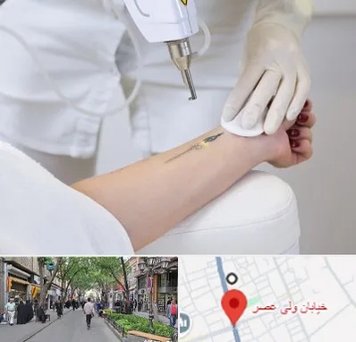 پاک کردن تتو با لیزر در ولیعصر شهریار