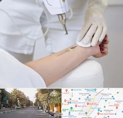 پاک کردن تتو با لیزر در شریعتی