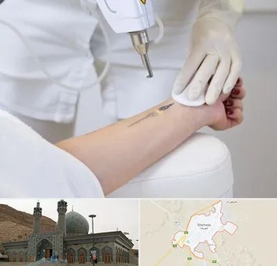 پاک کردن تتو با لیزر در شهرضا