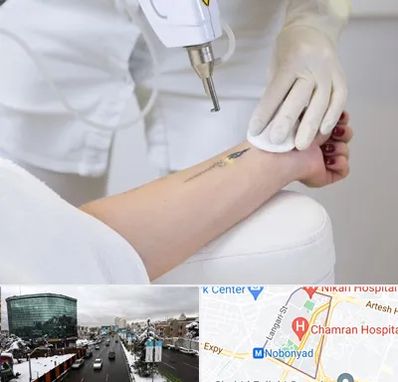 پاک کردن تتو با لیزر در اقدسیه