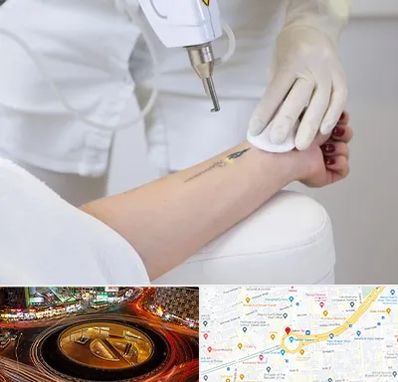 پاک کردن تتو با لیزر در میدان ولیعصر