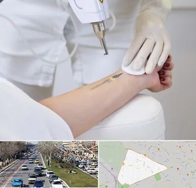 پاک کردن تتو با لیزر در احمدآباد مشهد