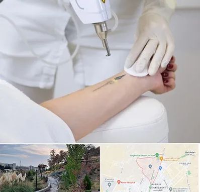 پاک کردن تتو با لیزر در باغستان کرج