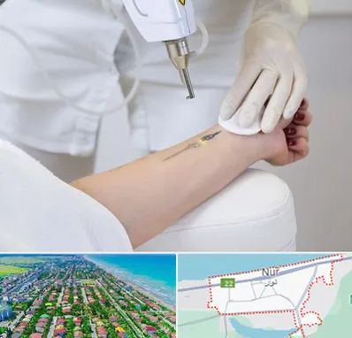 پاک کردن تتو با لیزر در نور