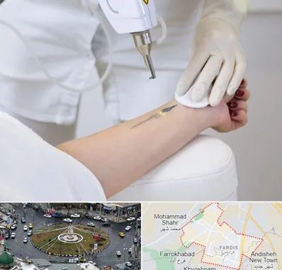 پاک کردن تتو با لیزر در فردیس کرج