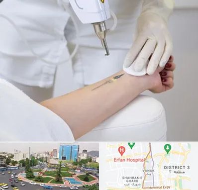 پاک کردن تتو با لیزر در ونک تهران