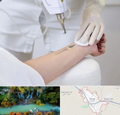 پاک کردن تتو با لیزر در دورود