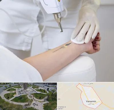 پاک کردن تتو با لیزر در ورامین