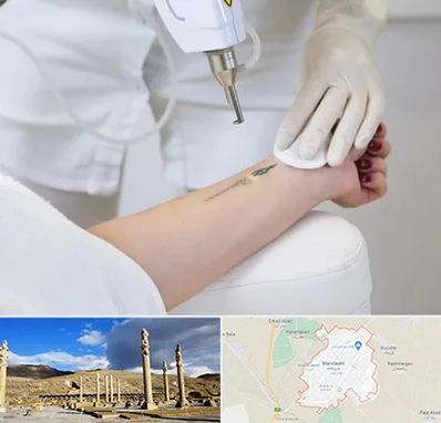 پاک کردن تتو با لیزر در مرودشت