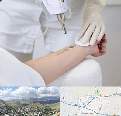 پاک کردن تتو با لیزر در رودهن